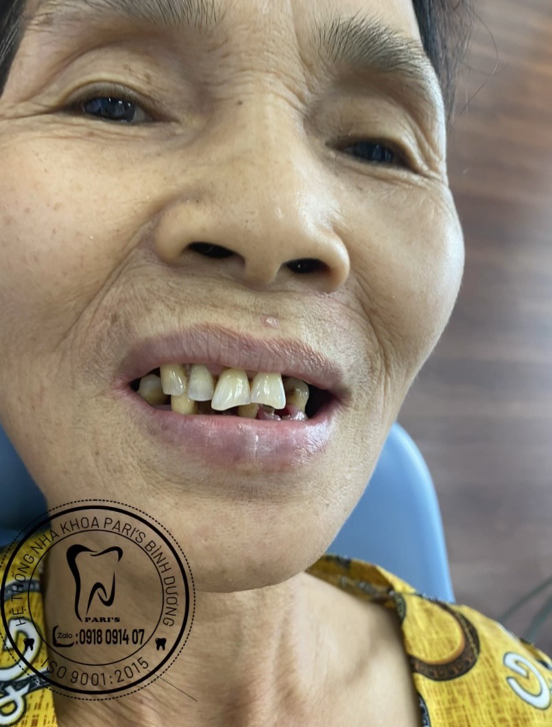 Trong Rang Bang Phuong Phap Implant 2